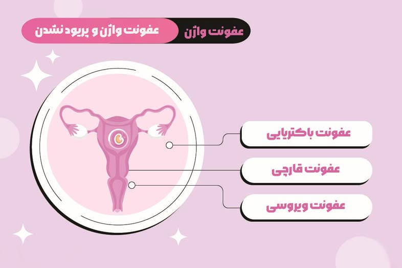 آیا عفونت قارچی واژن باعث تاخیر در پریود می شود؟